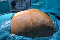 Phẫu thuật dị dạng lồng ngực cho bé trai 12 tuổi ở Phú Thọ