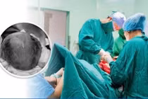 Cứu sống sản phụ rau bong non nguy kịch