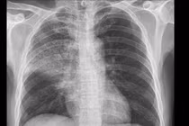 Điều trị thành công ca viêm phổi cộng đồng trên bệnh nhân xơ gan