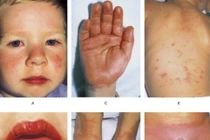 Kawasaki - bệnh viêm mạch nguy hiểm ở trẻ em