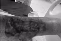 Chi hoại tử sau lóc da ở người đái tháo đường