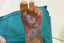 Cụ bà 80 tuổi suýt mất bàn chân vì vết xước nhỏ