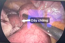 Nội soi cấp cứu người bệnh tắc ruột do dây chằng sau mổ