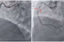Ngưng tim đột ngột do rối loạn nhịp phức tạp gây nguy hiểm
