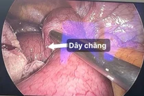 Nội soi cấp cứu người bệnh tắc ruột do dây chằng sau mổ