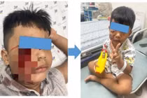 Cấp cứu trẻ 5 tuổi bị chó cắn rách nát mặt phải