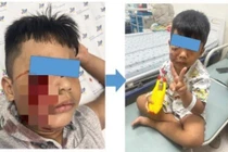 Cấp cứu trẻ 5 tuổi bị chó cắn rách nát mặt phải