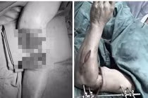 Nối thành công cánh tay đứt lìa cho bệnh nhân bị tai nạn lao động