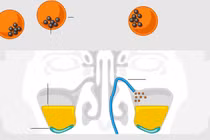 Ứng dụng vi robot trong xử lý viêm xoang bằng công nghệ cao