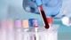 Có nên xét nghiệm DNA để phòng bệnh?