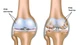 Bí quyết giảm đau xương khớp hiệu quả