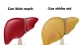 Gan nhiễm mỡ ngày càng phổ biến do lối sống hiện đại