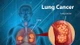 Ung thư phổi, ung thư đại trực tràng ngày càng trẻ hoá