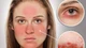 Nhận biết dấu hiệu lupus, phòng ngừa tổn thương nội tạng