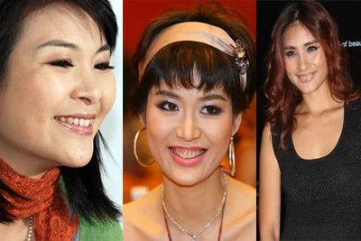 Những hàm răng “thế hệ tetracycline” của sao Việt