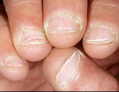 Nhìn móng tay đoán bệnh tim, gan, phổi ...