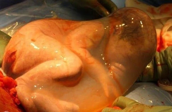 Chùm ảnh bé sơ sinh thu mình trong túi ối ngoài cơ thể mẹ