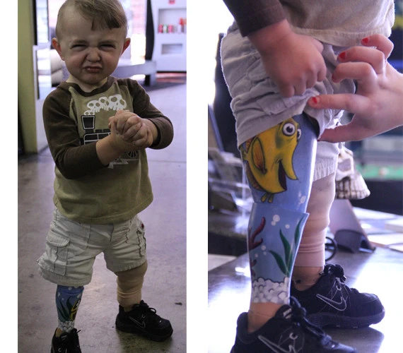 “Hình xăm” siêu cute của bé 2 tuổi mang chân giả