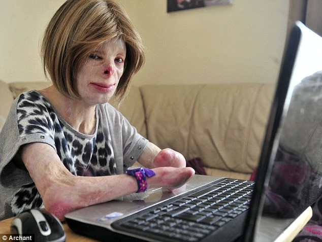 Kỳ diệu sức sống cô bé bỏng 90% cơ thể