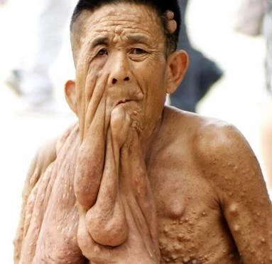 Hãi hùng những căn bệnh hiếm gặp trên thế giới (P1)