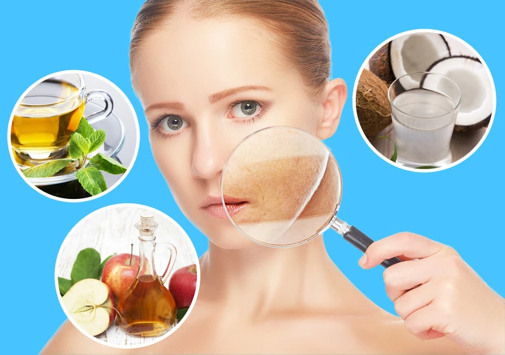 Bỏ túi những mẹo hay làm dịu da cháy nắng