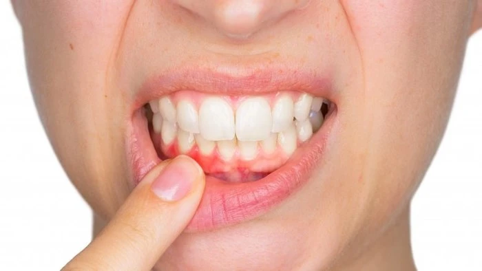 Điều gì xảy ra nếu bạn không đánh răng hàng ngày?