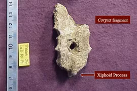 Lỗ tròn hoàn hảo trên hài cốt cổ đại, chuyên gia vén màn bí ẩn lớn