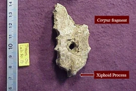 Lỗ tròn hoàn hảo trên hài cốt cổ đại, chuyên gia vén màn bí ẩn lớn