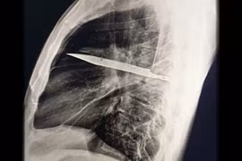 Khó tin người đàn ông sống với lưỡi dao cắm trong ngực 8 năm mà không biết