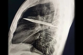 Khó tin người đàn ông sống với lưỡi dao cắm trong ngực 8 năm mà không biết