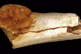 Giải mã trường hợp ung thư đầu tiên trong lịch sử nhân loại