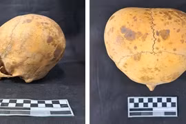  Sửng sốt hộp sọ người lạ 700 năm tuổi ở Argentina