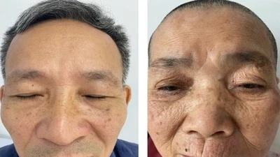 Liệt mặt do zona - hiểm họa khôn lường có thể phát hiện sớm