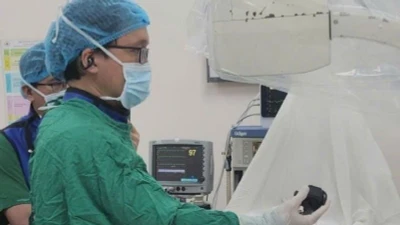 Thực hiện thành công ca tán sỏi túi mật xuyên gan qua da