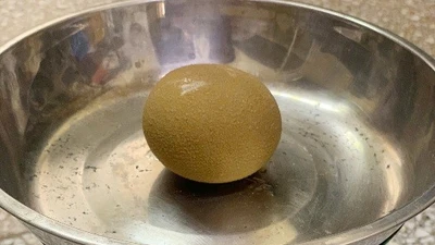 Lấy sỏi bàng quang to như quả cam ra khỏi cơ thể