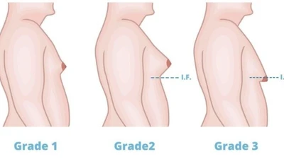 50 - 70% nam giới có dấu hiệu vú to, chớ nên chủ quan