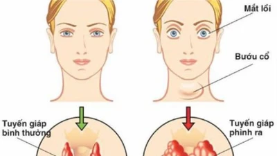 Ngừng thuốc kháng giáp có tái phát bệnh Basedow?