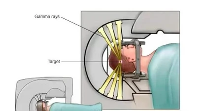 Ung thư di căn não điều trị thế nào hiệu quả?