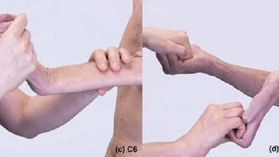 Tay mất vận động do liệt đám rối thần kinh