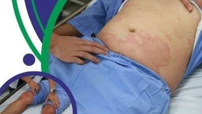 Ăn cơm với cá thu, người đàn ông 32 tuổi sốc phản vệ