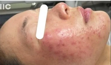Mảng đỏ trên mặt, cẩn thận bệnh trứng cá đỏ