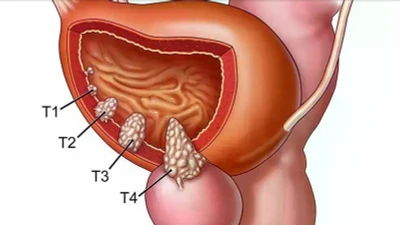 Địa chỉ vàng: Các bệnh viện điều trị tốt ung thư bàng quang
