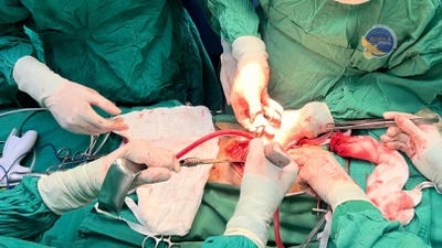 Bỏ khối u bàng quang khổng lồ giải cứu quả thận đang "chết đuối"