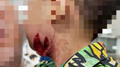 Nghỉ hè về quê, trẻ hơn 2 tuổi bị chó cắn nghiêm trọng 