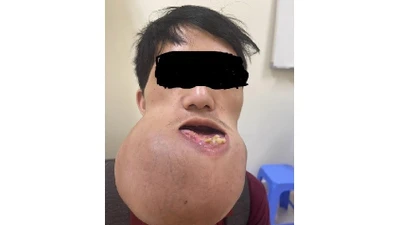 U xương khổng lồ ở chàng trai 24 tuổi không có tiền chữa trị