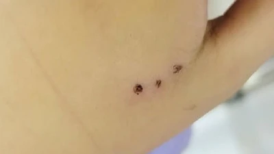 Trẻ 10 tuổi viêm tấy bàn tay do chuột cắn