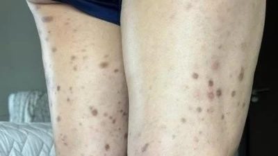 Sống chung với nốt sẩn ngứa 10 năm, không ngờ bệnh hiếm ác tính