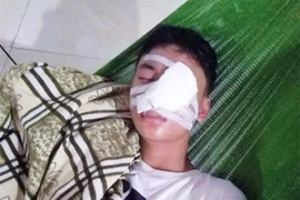 Nam sinh bị chó dữ tấn công phải khâu hơn 20 mũi ở mặt