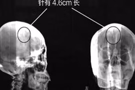 Kỳ lạ kim khâu nằm trong đầu mà không hay biết