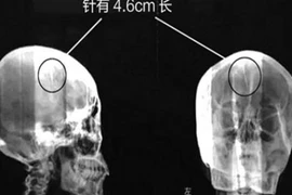 Kỳ lạ kim khâu nằm trong đầu mà không hay biết
